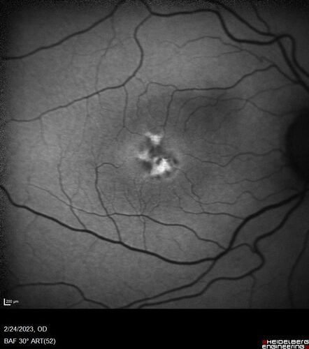 Pattern Dystrophy - PHPR2 Gene
57 year old man- VA 20/25 OD, 20/20 OS - Many family members have retinitis pigmentosa

