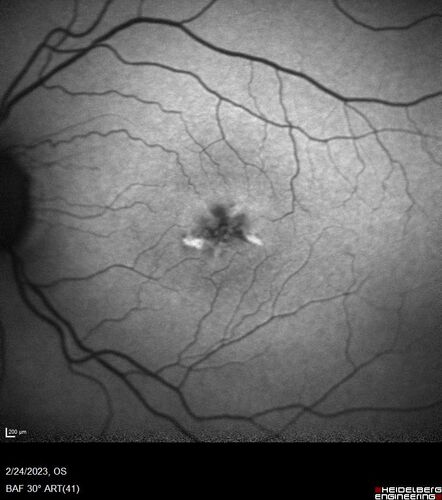 Pattern Dystrophy - PHPR2 Gene
57 year old man- VA 20/25 OD, 20/20 OS - Many family members have retinitis pigmentosa
