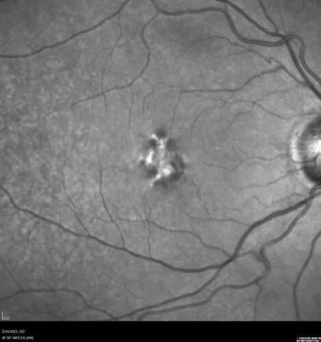 Pattern Dystrophy - PHPR2 Gene
57 year old man- VA 20/25 OD, 20/20 OS - Many family members have retinitis pigmentosa
