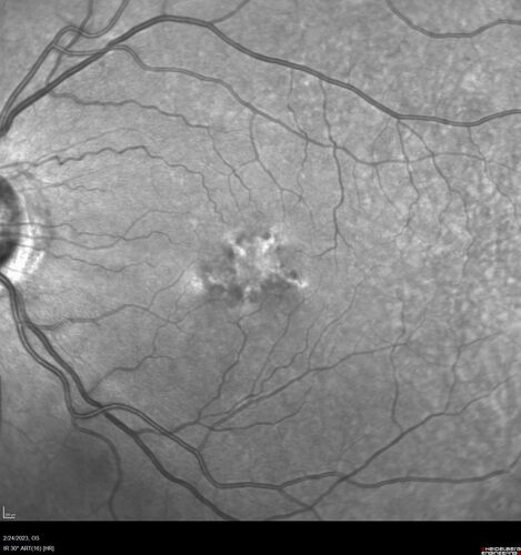 Pattern Dystrophy - PHPR2 Gene
57 year old man- VA 20/25 OD, 20/20 OS - Many family members have retinitis pigmentosa
