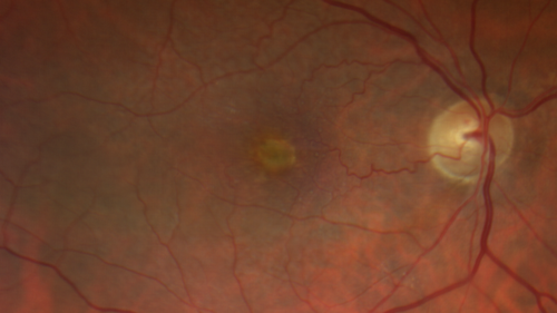Adult Pseudovitelliform Macular Dystrophy
89 year old female states dark smudge on ceiling during night time came and went.  Decreased vision in the left eye
VA OD: Dcc20/32
VA OS: Dcc20/63
