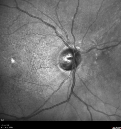 Adult Pseudovitelliform Macular Dystrophy
89 year old female states dark smudge on ceiling during night time came and went.  Decreased vision in the left eye
VA OD: Dcc20/32
VA OS: Dcc20/63

