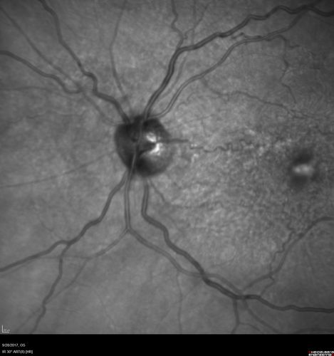 Adult Pseudovitelliform Macular Dystrophy
89 year old female states dark smudge on ceiling during night time came and went.  Decreased vision in the left eye
VA OD: Dcc20/32
VA OS: Dcc20/63
