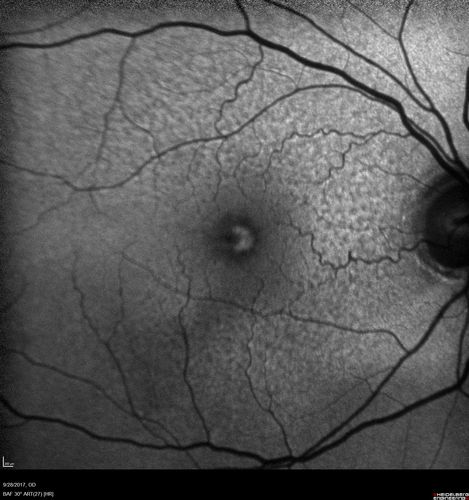 Adult Pseudovitelliform Macular Dystrophy
89 year old female states dark smudge on ceiling during night time came and went.  Decreased vision in the left eye
VA OD: Dcc20/32
VA OS: Dcc20/63

