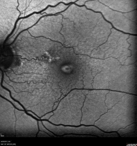 Adult Pseudovitelliform Macular Dystrophy
89 year old female states dark smudge on ceiling during night time came and went.  Decreased vision in the left eye
VA OD: Dcc20/32
VA OS: Dcc20/63
