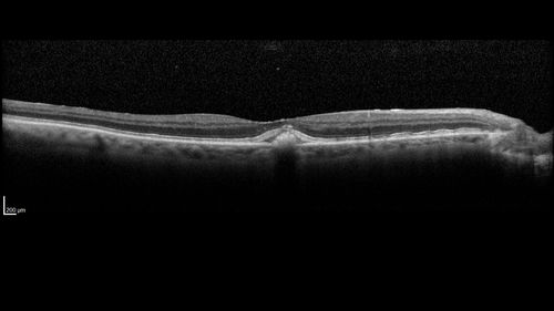 Adult Pseudovitelliform Macular Dystrophy
89 year old female states dark smudge on ceiling during night time came and went.  Decreased vision in the left eye
VA OD: Dcc20/32
VA OS: Dcc20/63
