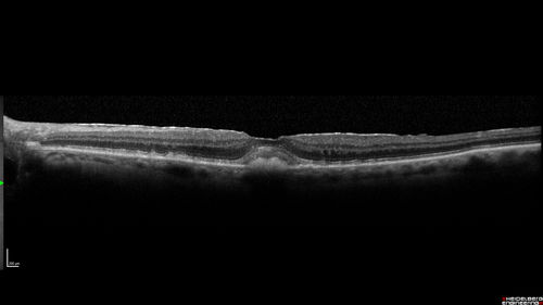Adult Pseudovitelliform Macular Dystrophy
89 year old female states dark smudge on ceiling during night time came and went.  Decreased vision in the left eye
VA OD: Dcc20/32
VA OS: Dcc20/63
