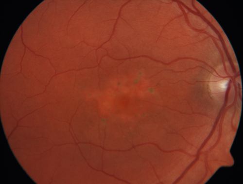 Pattern Dystrophy - Probably Early Butterfly
33 year old with normal vision and no visual complaints - normal color vision
