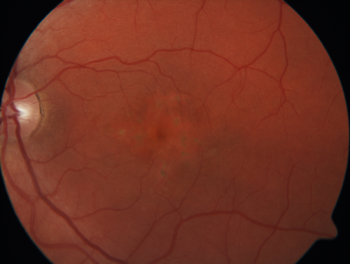 Pattern Dystrophy - Probably Early Butterfly
33 year old with normal vision and no visual complaints - normal color vision
