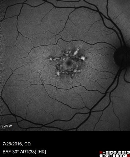 Pattern Dystrophy - Probably Early Butterfly
33 year old with normal vision and no visual complaints - normal color vision
