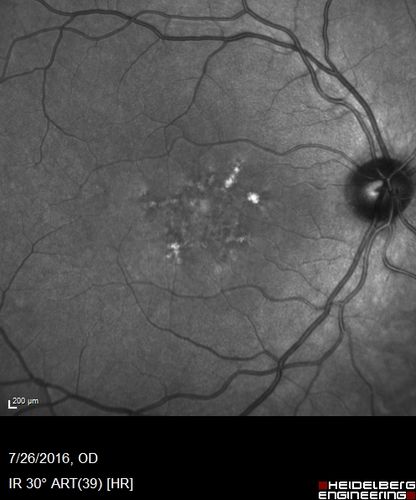 Pattern Dystrophy - Probably Early Butterfly
33 year old with normal vision and no visual complaints - normal color vision
