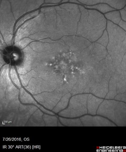 Pattern Dystrophy - Probably Early Butterfly
33 year old with normal vision and no visual complaints - normal color vision
