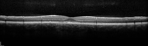 Pattern Dystrophy - Probably Early Butterfly
33 year old with normal vision and no visual complaints - normal color vision
