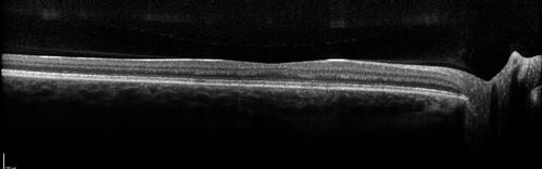 Pattern Dystrophy - Probably Early Butterfly
33 year old with normal vision and no visual complaints - normal color vision
