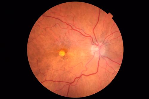 Pattern Dystrophy - Foveal Atrophy
73 year old female with vision loss - looks like macular hole
