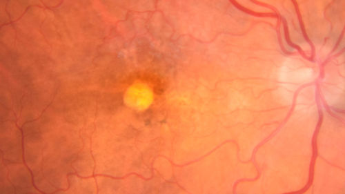 Pattern Dystrophy - Foveal Atrophy
73 year old female with vision loss - looks like macular hole
