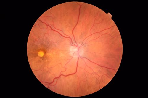 Pattern Dystrophy - Foveal Atrophy
73 year old female with vision loss - looks like macular hole
