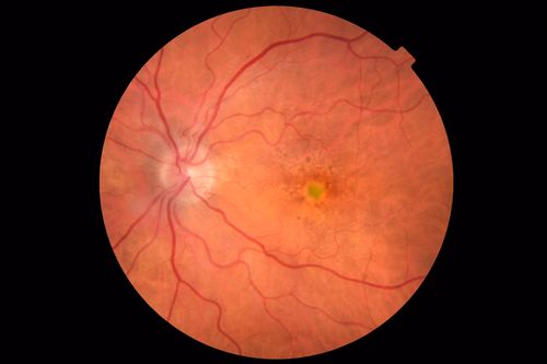 Pattern Dystrophy - Foveal Atrophy
73 year old female with vision loss - looks like macular hole
