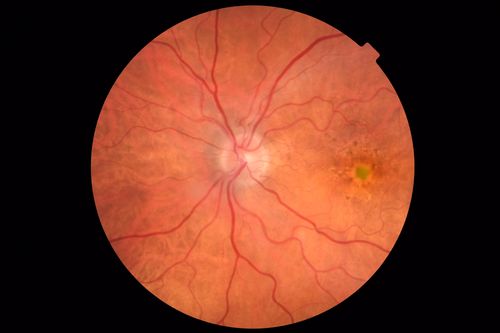 Pattern Dystrophy - Foveal Atrophy
73 year old female with vision loss - looks like macular hole

