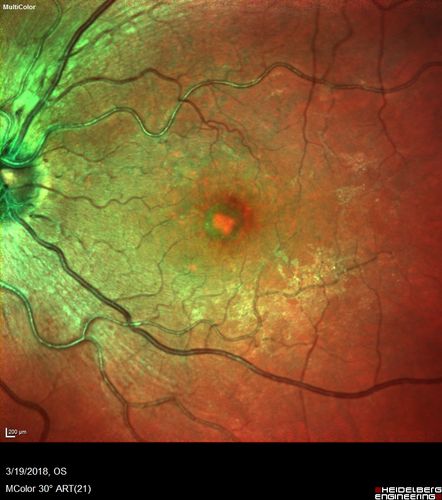 Pattern Dystrophy - Foveal Atrophy
73 year old female with vision loss - looks like macular hole
