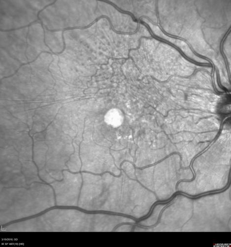 Pattern Dystrophy - Foveal Atrophy
73 year old female with vision loss - looks like macular hole
