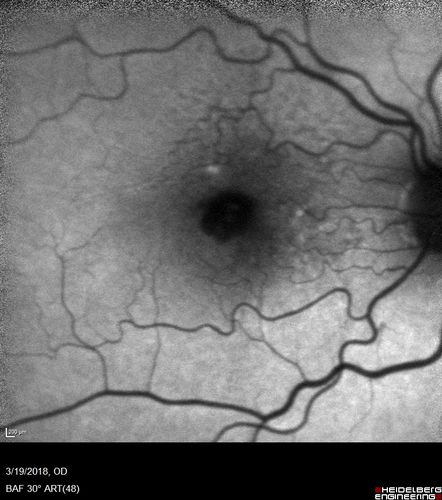 Pattern Dystrophy - Foveal Atrophy
73 year old female with vision loss - looks like macular hole
