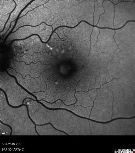 Pattern Dystrophy - Foveal Atrophy
73 year old female with vision loss - looks like macular hole
