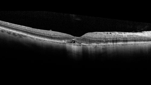 Pattern Dystrophy - Foveal Atrophy
73 year old female with vision loss - looks like macular hole
