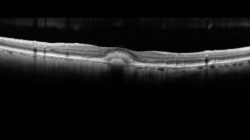 Pattern Dystrophy - Foveal Atrophy
73 year old female with vision loss - looks like macular hole
