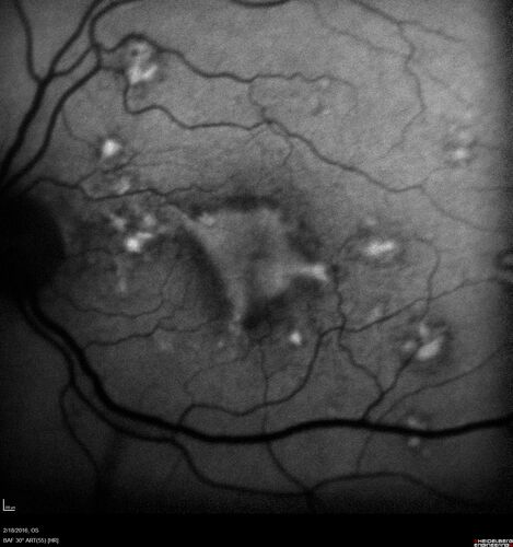 Pattern dystrophy with progressive foveal atrophy left eye
72 year old man.  Vision in the left eye is 20/80.  It declined to 5/200 over about 3 years.
