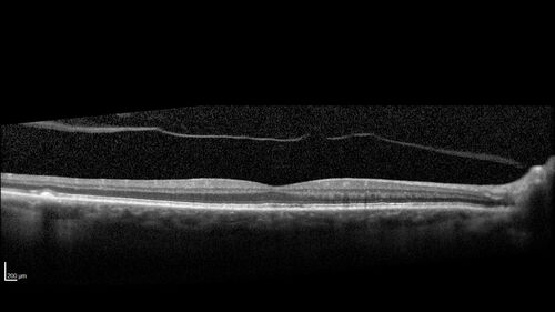 Pattern dystrophy with progressive foveal atrophy left eye
72 year old man.  Vision in the left eye is 20/80.  It declined to 5/200 over about 3 years.
