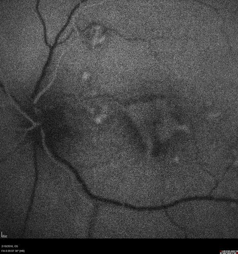 Pattern dystrophy with progressive foveal atrophy left eye
72 year old man.  Vision in the left eye is 20/80.  It declined to 5/200 over about 3 years.
