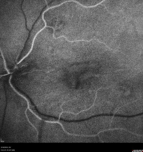 Pattern dystrophy with progressive foveal atrophy left eye
72 year old man.  Vision in the left eye is 20/80.  It declined to 5/200 over about 3 years.
