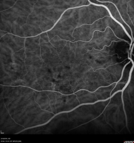 Pattern dystrophy with progressive foveal atrophy left eye
72 year old man.  Vision in the left eye is 20/80.  It declined to 5/200 over about 3 years.
