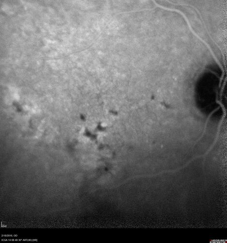 Pattern dystrophy with progressive foveal atrophy left eye
72 year old man.  Vision in the left eye is 20/80.  It declined to 5/200 over about 3 years.
