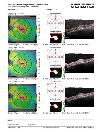 Pattern dystrophy with progressive foveal atrophy left eye
72 year old man.  Vision in the left eye is 20/80.  It declined to 5/200 over about 3 years.

