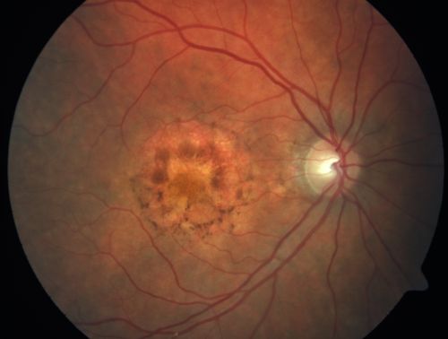 Patterned Pigment Dystrophy of the Fovea 2 year later VA still good
