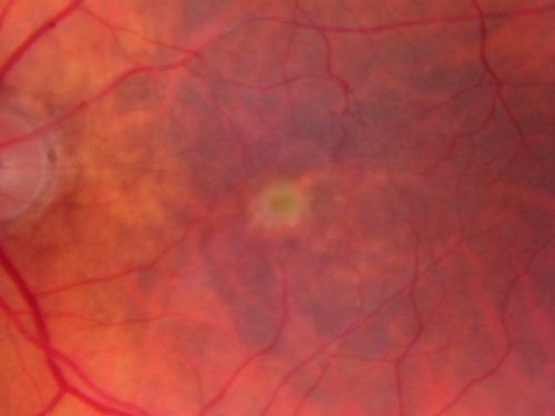 Pattern Dystrophy - Adult Vitelliform - 95 Year Old Man with Good Vision
95-year-old man in excellent health and he doesnâ€™t notice a vision problem.   OD 20/32,  OS 20/80
