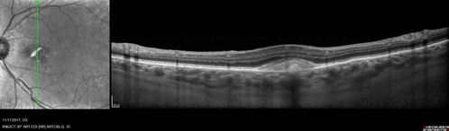 Pattern Dystrophy - Adult Vitellifrom (Best)
71 year old female - lesions nasal to the fovea in both eyes. (20/40 OU)
