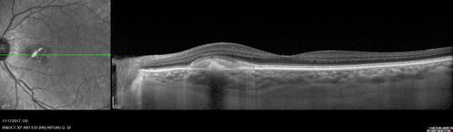 Pattern Dystrophy - Adult Vitellifrom (Best)
71 year old female - lesions nasal to the fovea in both eyes. (20/40 OU)
