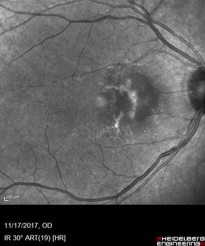 Pattern Dystrophy - Adult Vitellifrom (Best)
71 year old female - lesions nasal to the fovea in both eyes. (20/40 OU)
