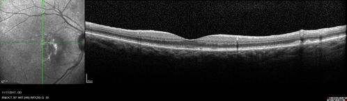 Pattern Dystrophy - Adult Vitellifrom (Best)
71 year old female - lesions nasal to the fovea in both eyes. (20/40 OU)
