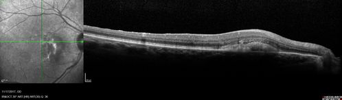 Pattern Dystrophy - Adult Vitellifrom (Best)
71 year old female - lesions nasal to the fovea in both eyes. (20/40 OU)

