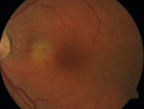 Pattern Dystrophy - Adult Vitellifrom (Best)
71 year old female - lesions nasal to the fovea in both eyes. (20/40 OU)

