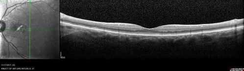 Pattern Dystrophy - Adult Vitellifrom (Best)
71 year old female - lesions nasal to the fovea in both eyes. (20/40 OU)
