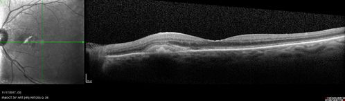 Pattern Dystrophy - Adult Vitellifrom (Best)
71 year old female - lesions nasal to the fovea in both eyes. (20/40 OU)
