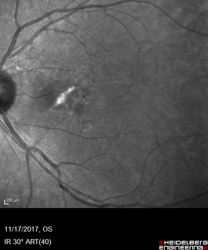 Pattern Dystrophy - Adult Vitellifrom (Best)
71 year old female - lesions nasal to the fovea in both eyes. (20/40 OU)
