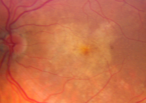 Pattern Dystrophy - Congenital Deafness - Diabetes - Developmental Delay - Fundus Photo Left Eye - Yellow Submacular Deposits
45-year-old woman congenitally deaf. She has diabetes for the last two years.  She also has developed mental delay and memory problems.  OD 20/200, OS 20/50.   She has sluggish pupillary responses in both eyes.  

Keywords: unkown;dystrophy;deaf
