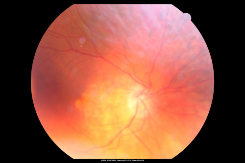 Pattern Dystrophy - Congenital Deafness - Diabetes - Developmental Delay - Fundus Photo Right Eye Yellow Submacular Deposits
45-year-old woman congenitally deaf. She has diabetes for the last two years.  She also has developed mental delay and memory problems.  OD 20/200, OS 20/50.   She has sluggish pupillary responses in both eyes.  

Keywords: unkown;dystrophy;deaf