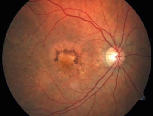 Patterned Pigment Dystrophy of the Fovea 79 YO Woman VA 20/20 Right 20/30 Left
